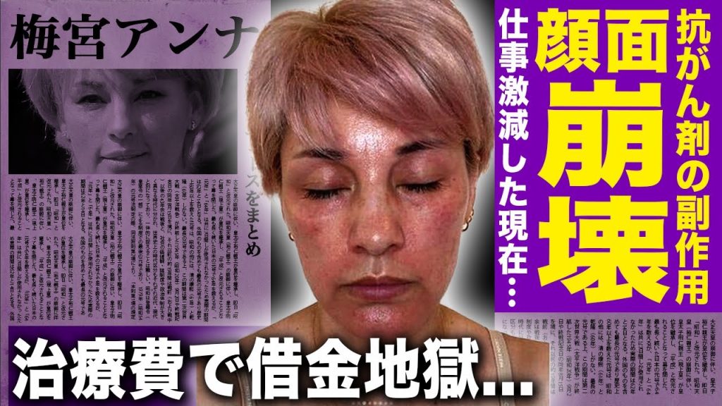 【驚愕】梅宮アンナが抗がん剤の副作用で顔面崩壊...仕事激減し変わり果てた現在に言葉を失う！がん治療の費用払えず借金生活...羽賀研二にヤり捨てされ精神が壊れた過去に驚きを隠せない...